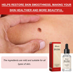 Liquido anti talpa e verruca 30 ml per macchie scure